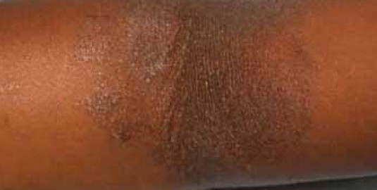 skin with lichenification