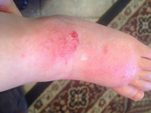 This happened while I was sitting in the bank drive-thru. We went to urgent care from there.