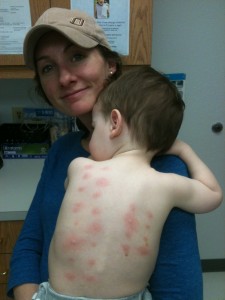 Our first skin test with our allergist on 3/13/2014.