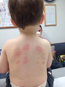 Our 2nd skin test, July 17, 2014