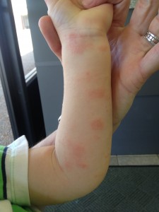 Eczema was in new places on his body that hadn't really been problems before.